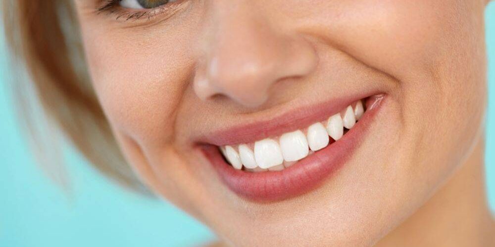 sbiancamento dentale