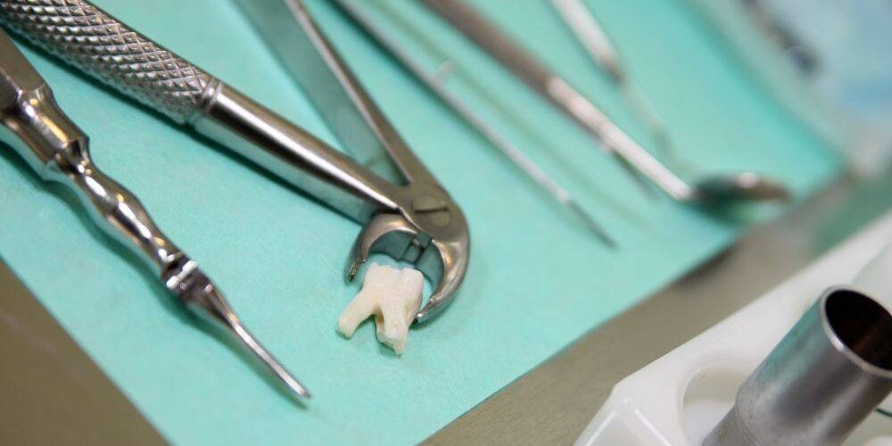 impianto dentale dopo estrazione