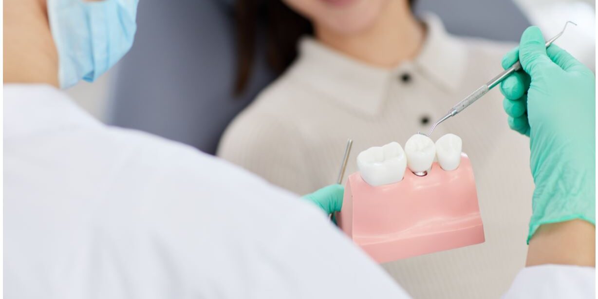 cura impianti dentali