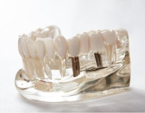 Implantologia dente implantologo