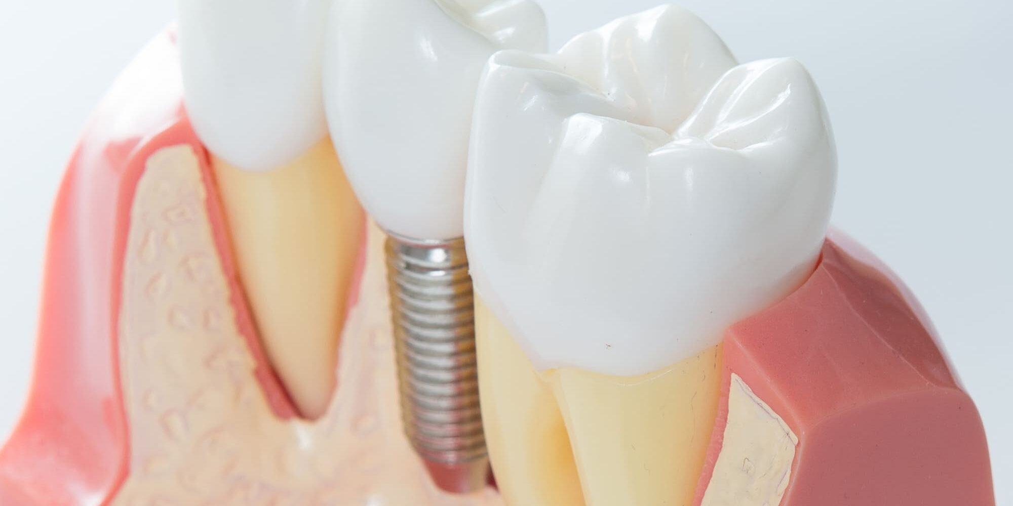 certificazione impianti dentali certificazione impianti dentali