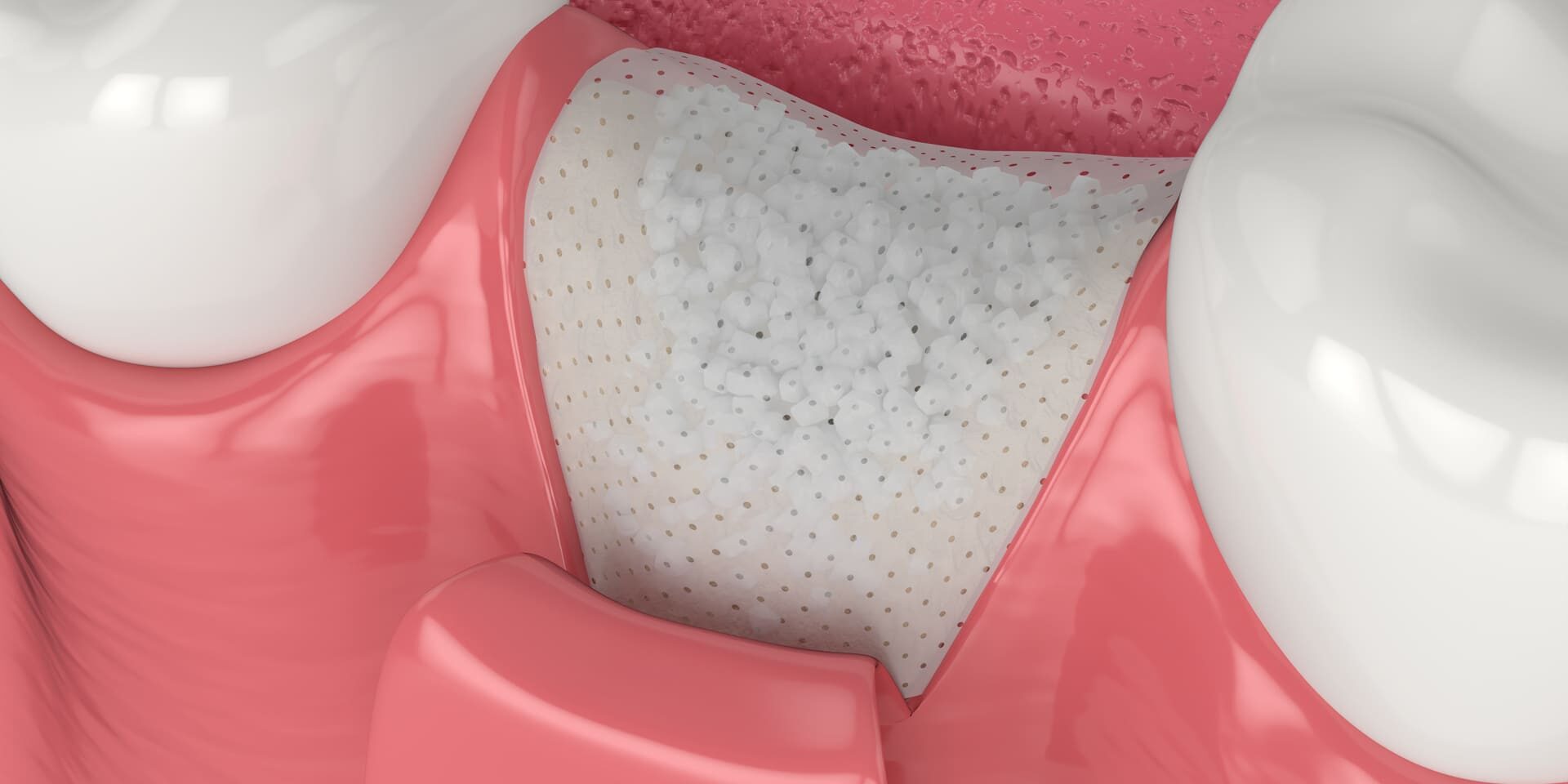 rigenerazione ossea dentale