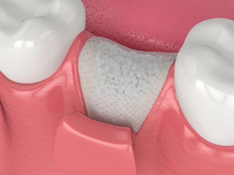 rigenerazione ossea dentale rigenerazione ossea dentale