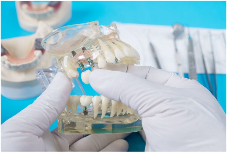 impianto dentale quando impianto dentale quando