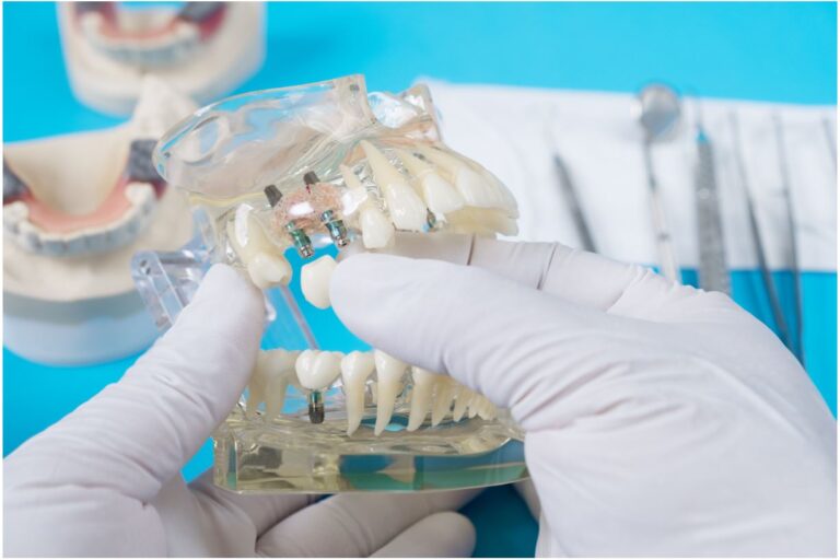 impianto dentale quando