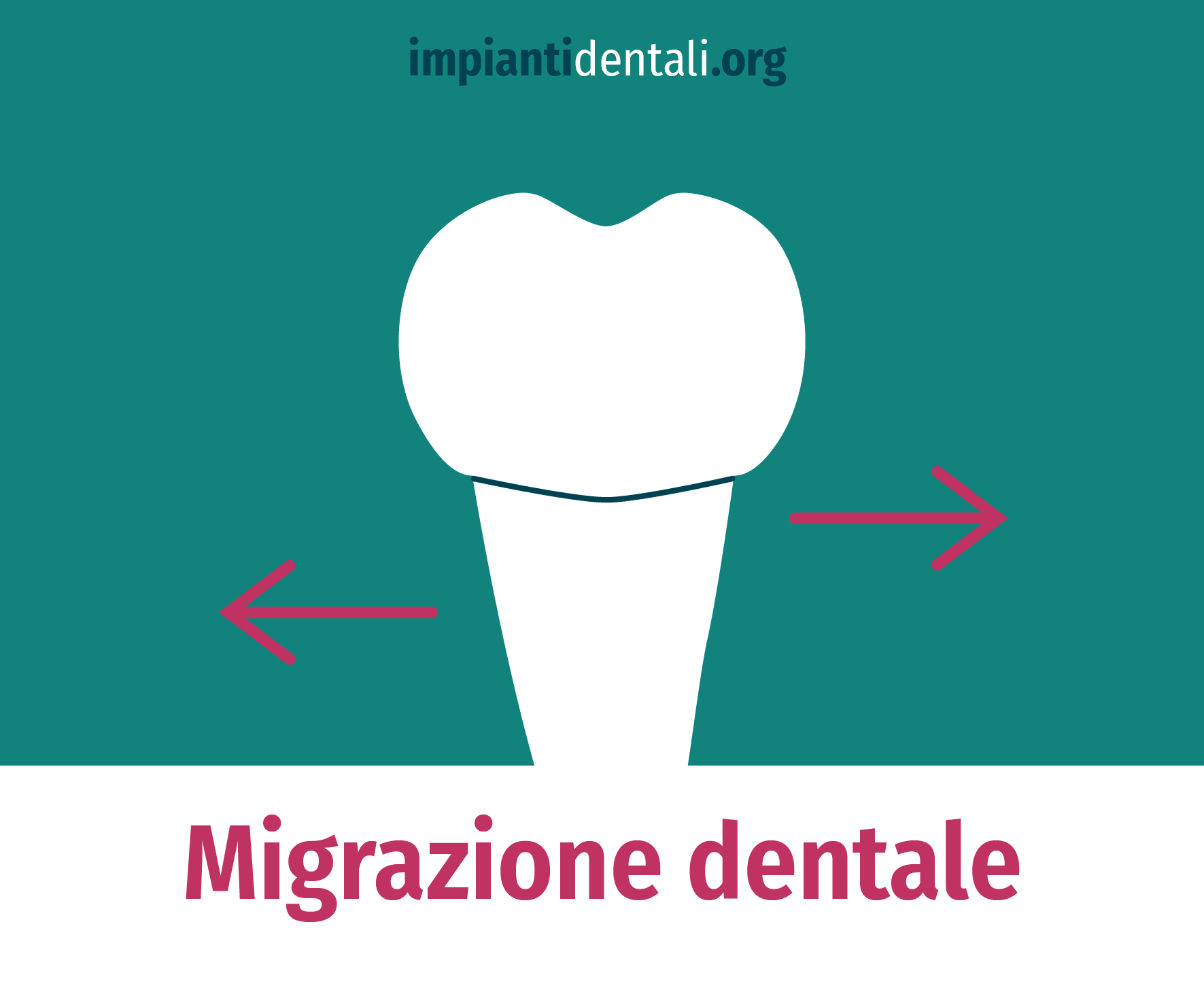 Migrazione Dentale