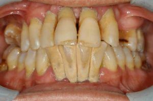 parodontite generalizzata e severa