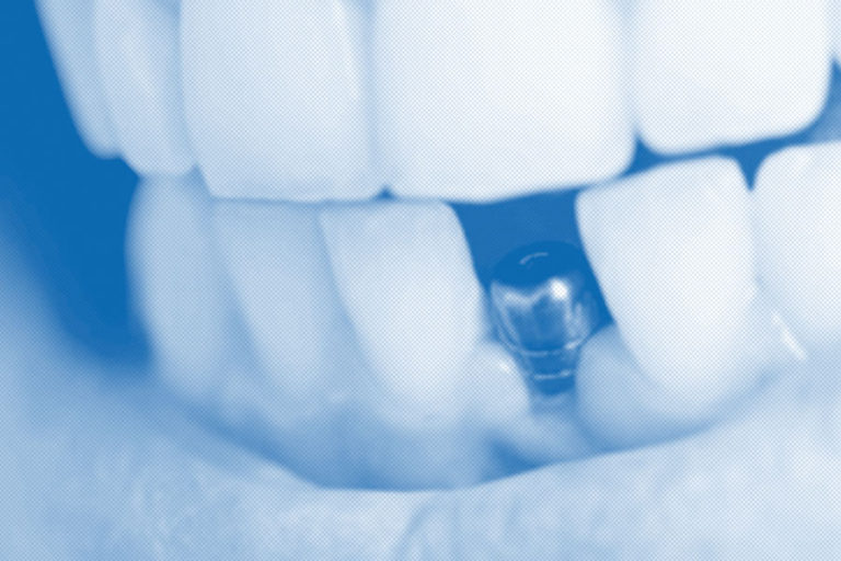 vantaggi impianti dentali