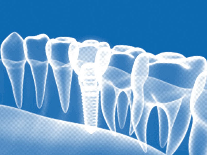A cosa servono gli impianti dentali?