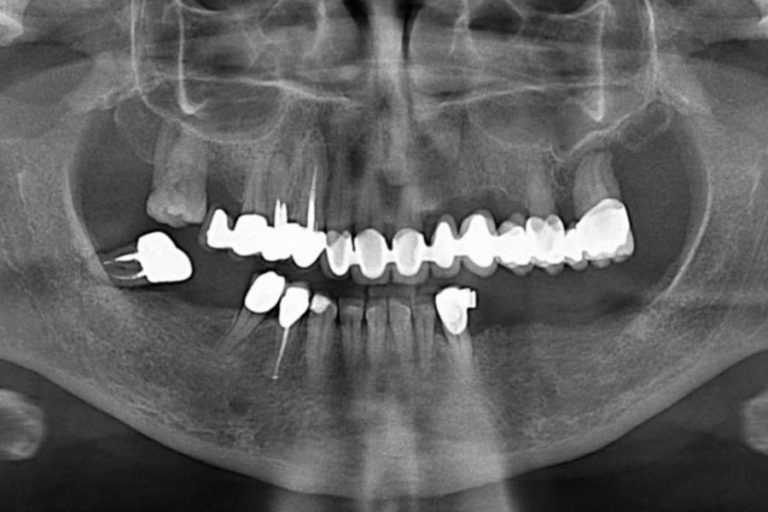 radiografie impianti dentali