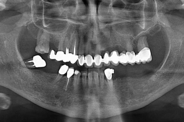 radiografie impianti dentali radiografie impianti dentali