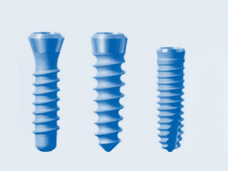 Perché gli impianti dentali non sono tutti uguali?
