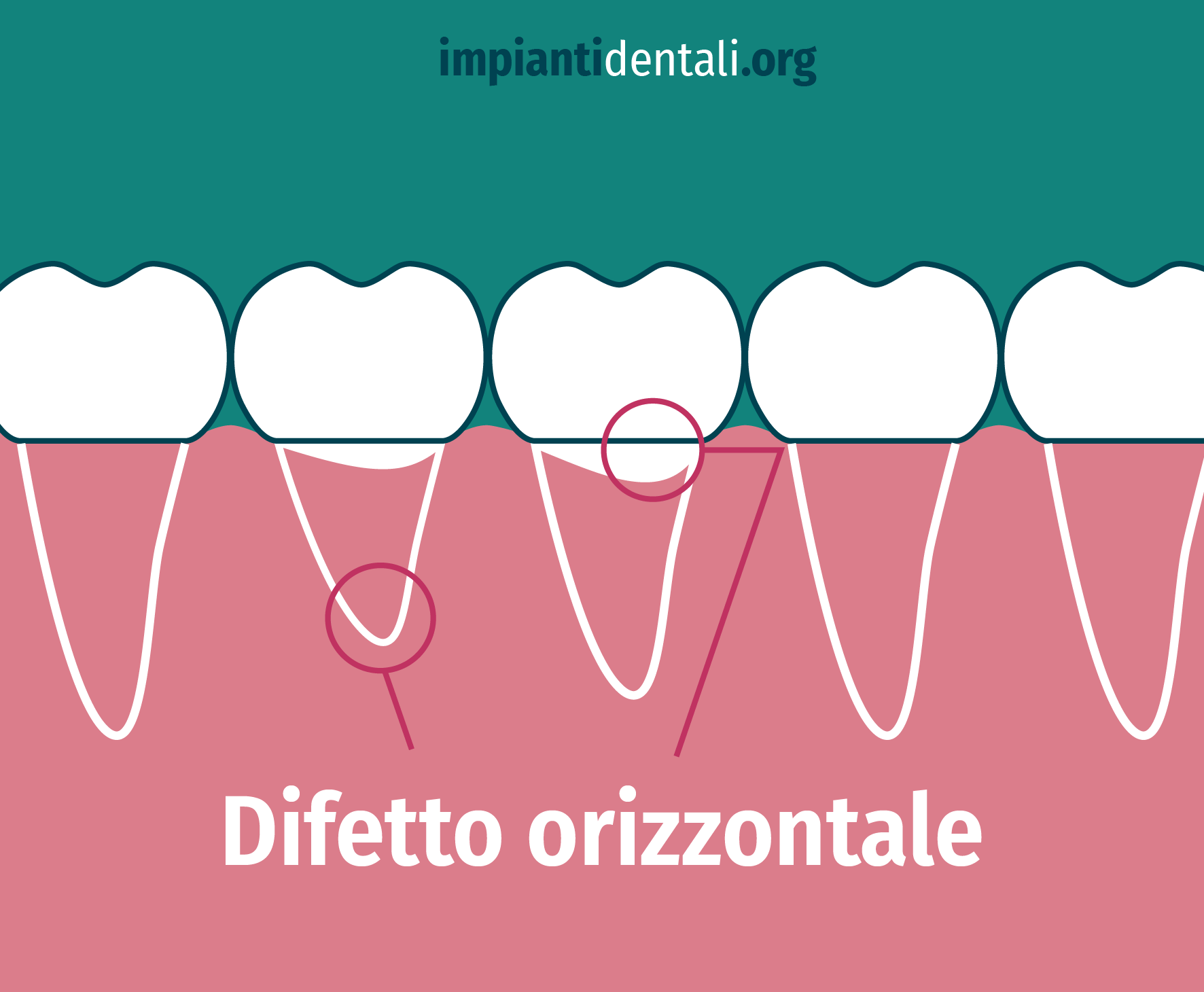 difetto orizzontale