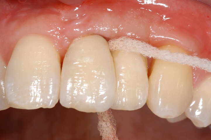 Mantenimento e cura degli impianti dentali