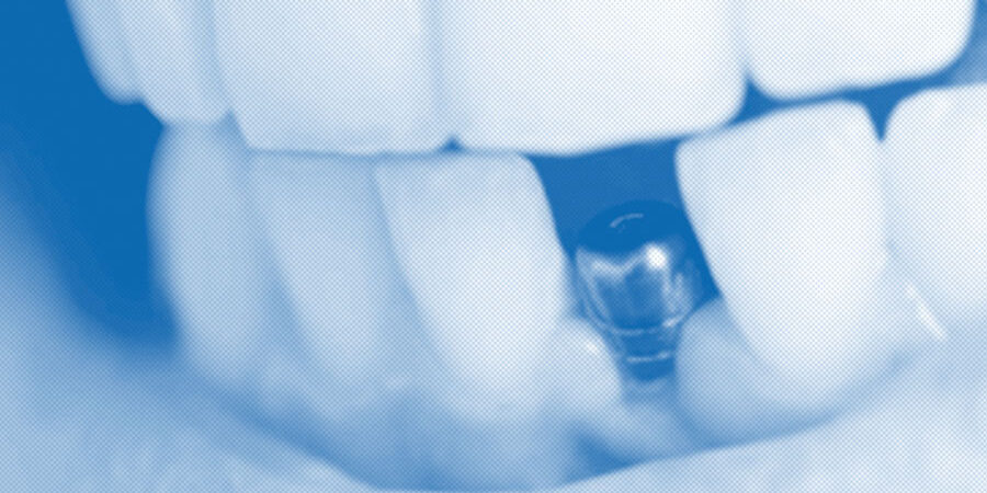 vantaggi impianti dentali