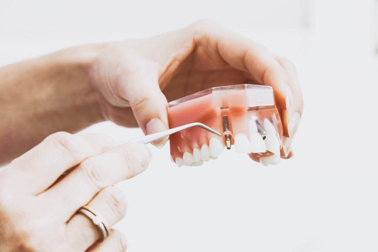 pulizia impianti dentali pulizia impianti dentali