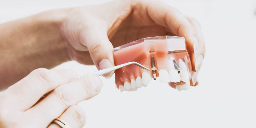 pulizia impianti dentali