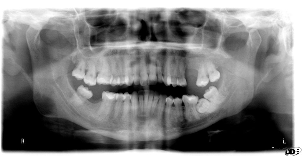 Radiografie in implantologia: quali sono necessarie?