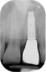 Radiografie in implantologia: quali sono necessarie?