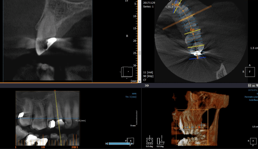 Radiografie in implantologia: quali sono necessarie?