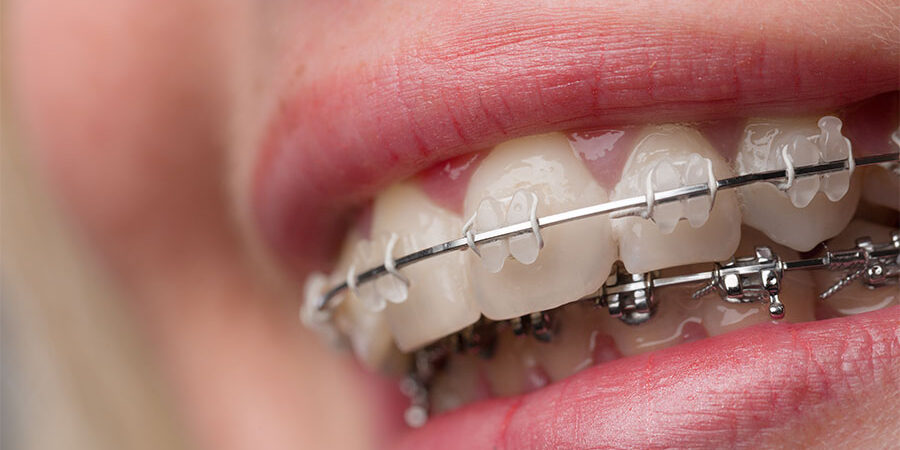 L’apparecchio è efficace nel curare la parodontite?