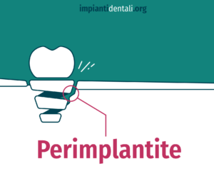 perimplantite