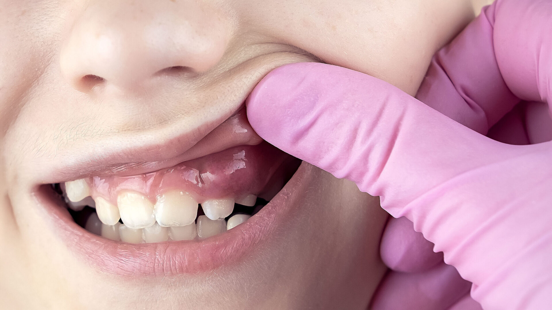 Gengive gonfie perché e cosa fare? •