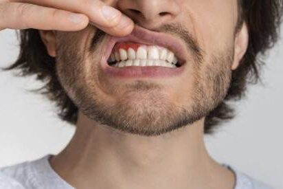 gengiva gonfia cosa fare gengiva gonfia cosa fare