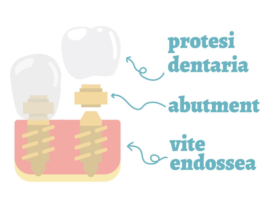 impianti dentali