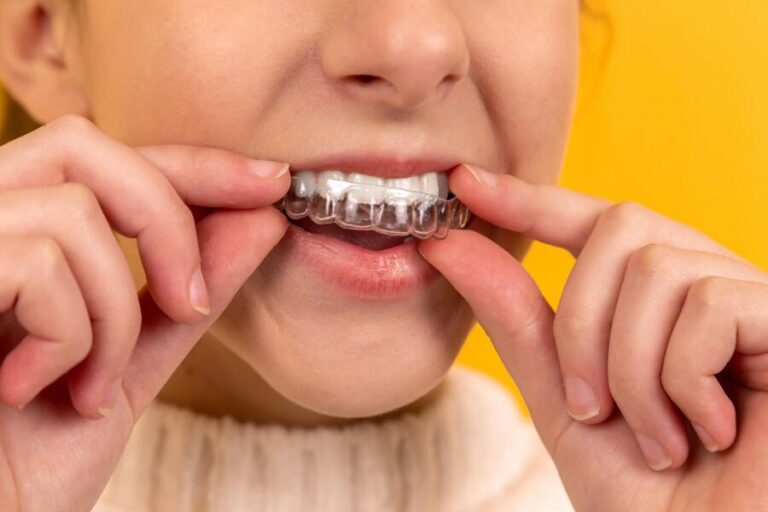 Ortodonzia invisibile: come mantenere una buona igiene orale ortodonzia invisibile