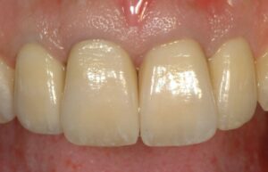 Protesi su impianti cementazione