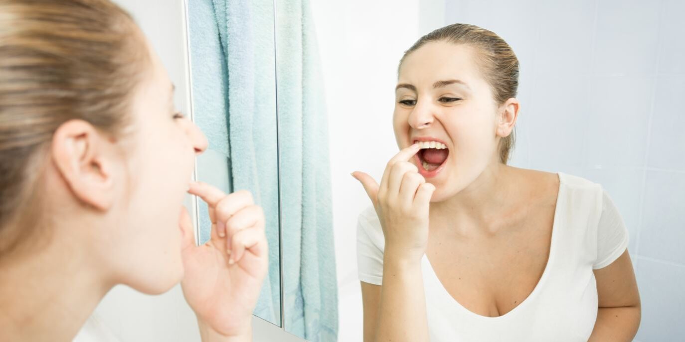 Gengive bianche Gengive bianche