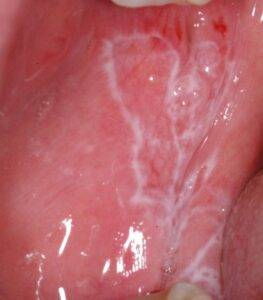 Lichen Planus Orale