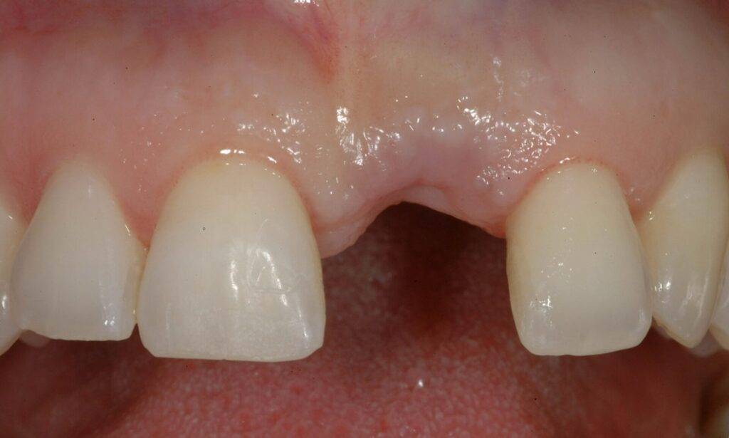 agenesia dentale