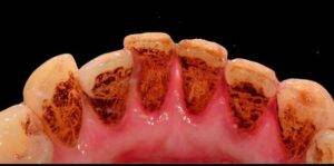 esempio di discromie dentali