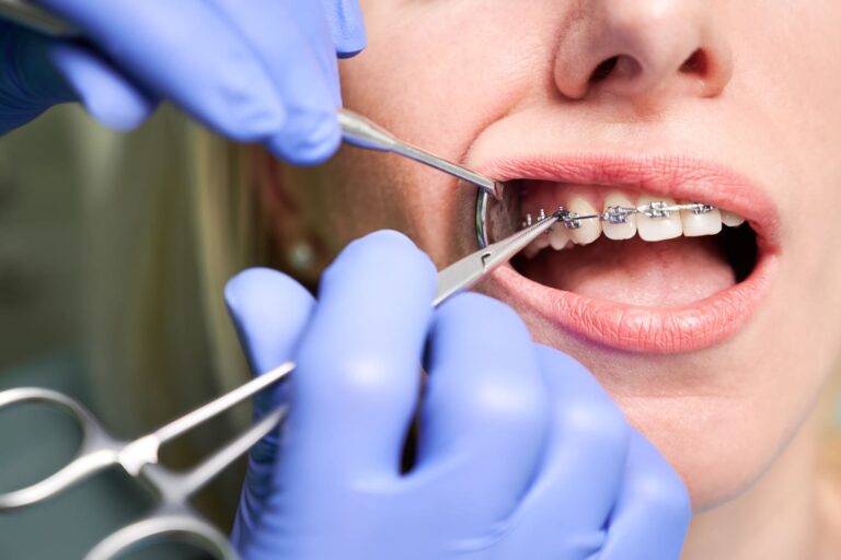 denti storti parodontite