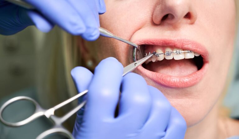 denti storti parodontite denti storti parodontite
