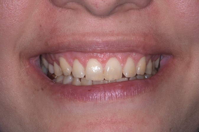 gengivectomia per sorriso gengivale