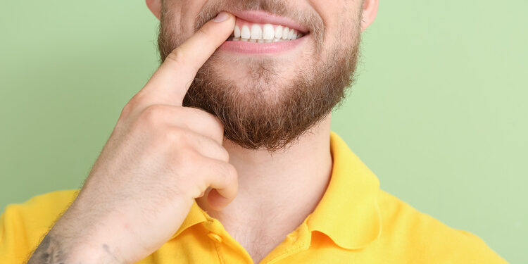 fistola gengivale fistola gengivale