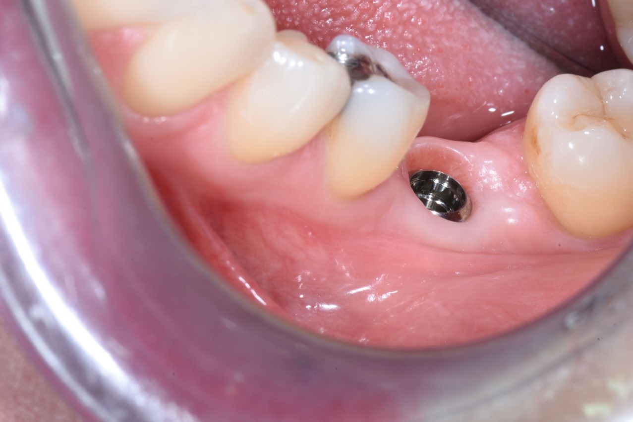 implantologia ossea dentale