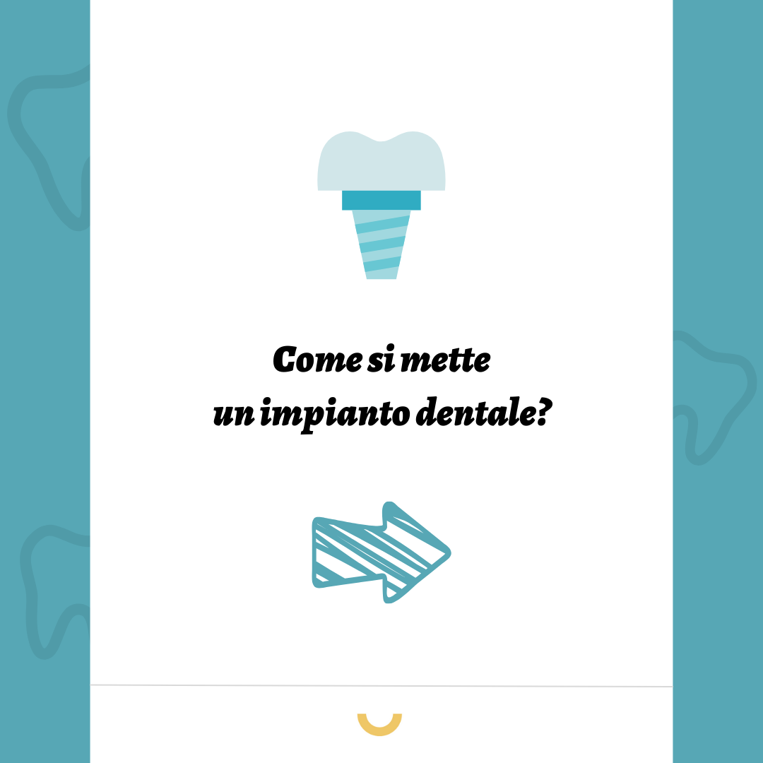 implantologia dentale fasi
