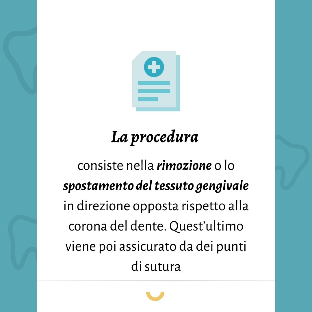 allungamento di corona clinica tecnica