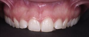 allungamento corona clinica prima