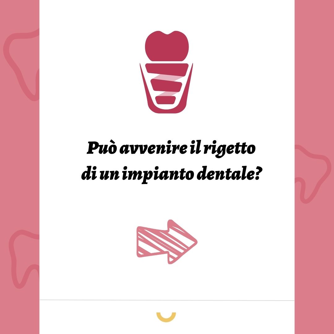 Pu&ograve; avvenire il rigetto di un impianto dentale?
