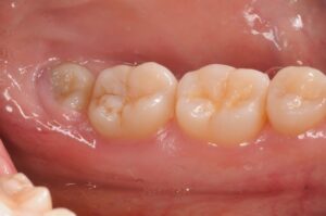 pericoronite dente del giudizio