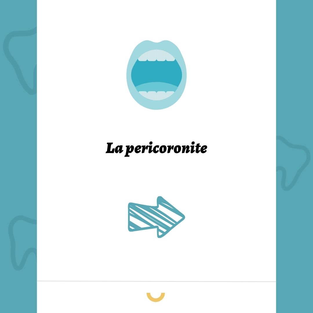 Pericoronite
