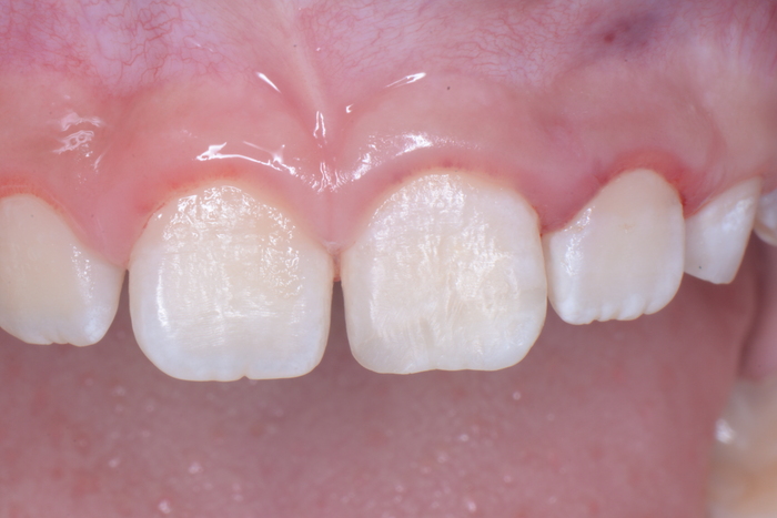 foto gengivite bambini