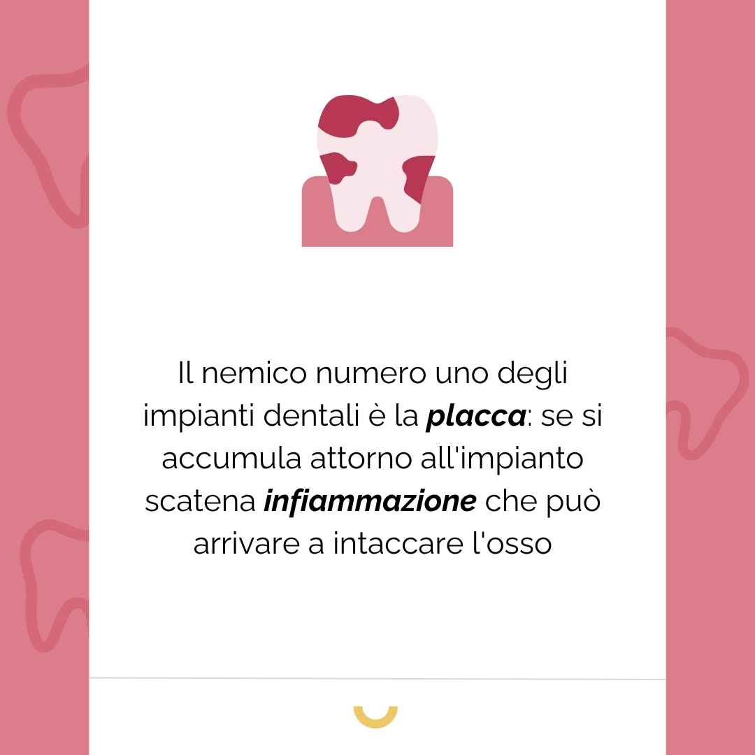 pulizia impianti dentali
